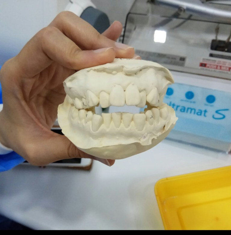 3 things to know about the cost of braces in Malaysia FMT