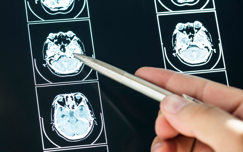 6 potential outcomes of traumatic brain injury | FMT