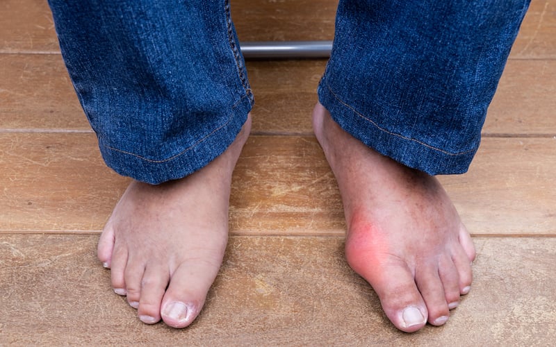 Gout can be a real pain in the foot FMT