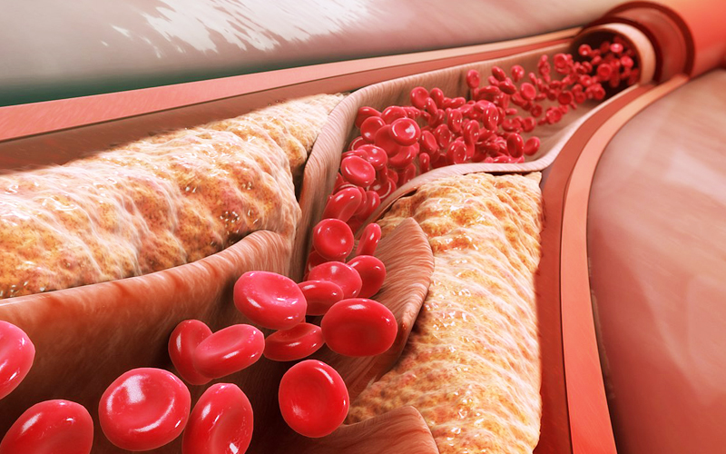 The Great Cholesterol Scam and the Dangers of Statins