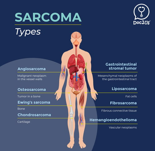 Understanding sarcoma, a form of bone cancer | FMT